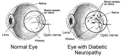 Photograph of the retina showing abnormal new blood vessels and scar 