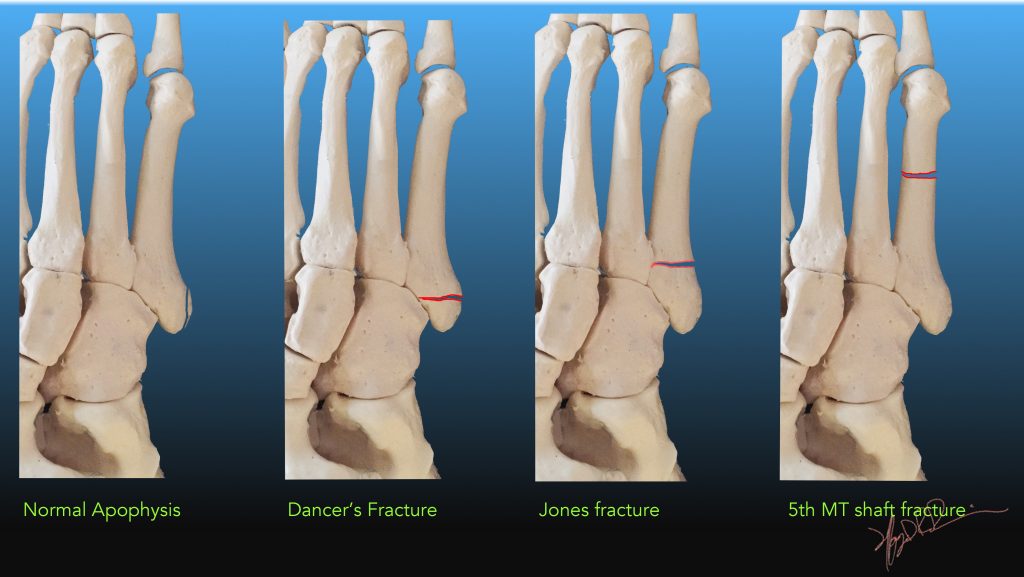 What Is Dancers Fracture