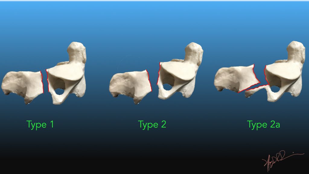 levine-edwards-classification-of-hangman-s-c2-fracture-uw