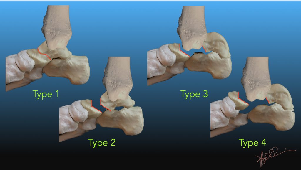 talus bone fracture