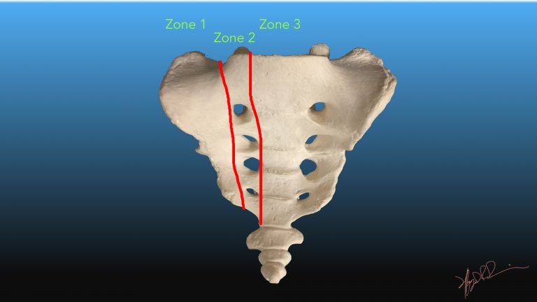 Denis Classification Of Sacral Fractures Uw Emergency Radiology