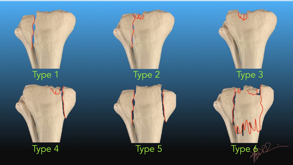 tibial plateau fracture mri