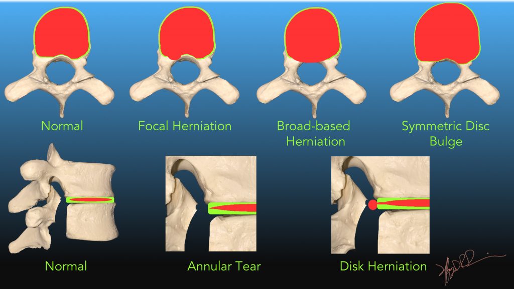 intervertebral disc herniation