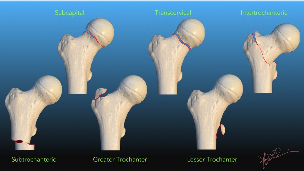 icd 10 code for right basicervical femoral neck fracture