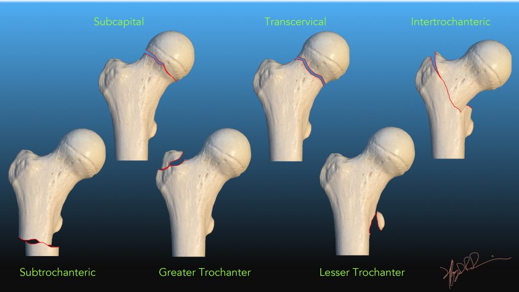 hip fracture types