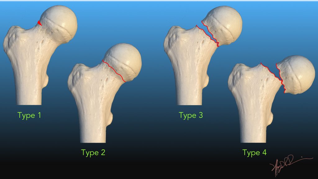 hip fracture types