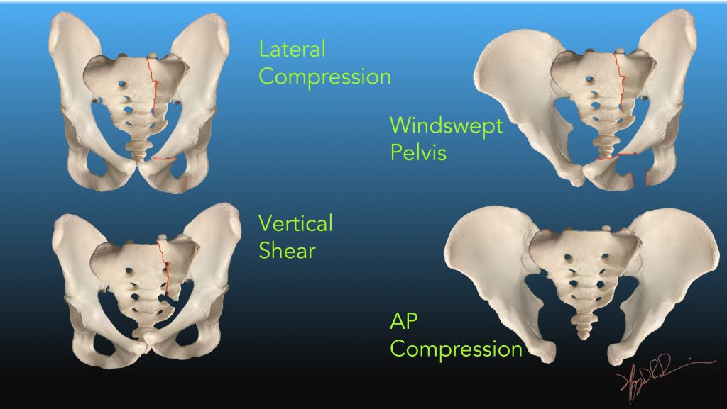 Grade 3 AP compression fracture of the pelvis