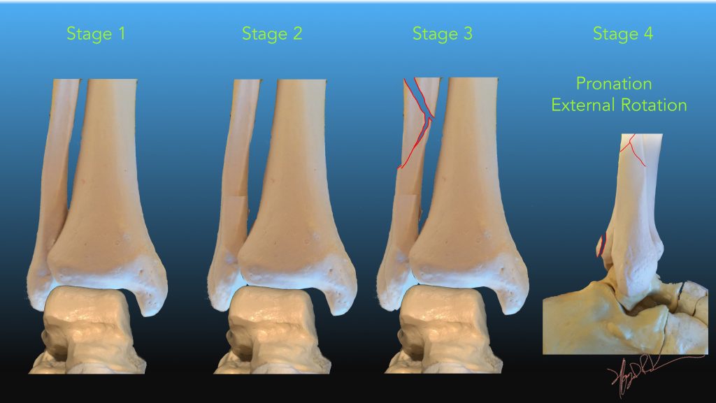 types of fibular fractures