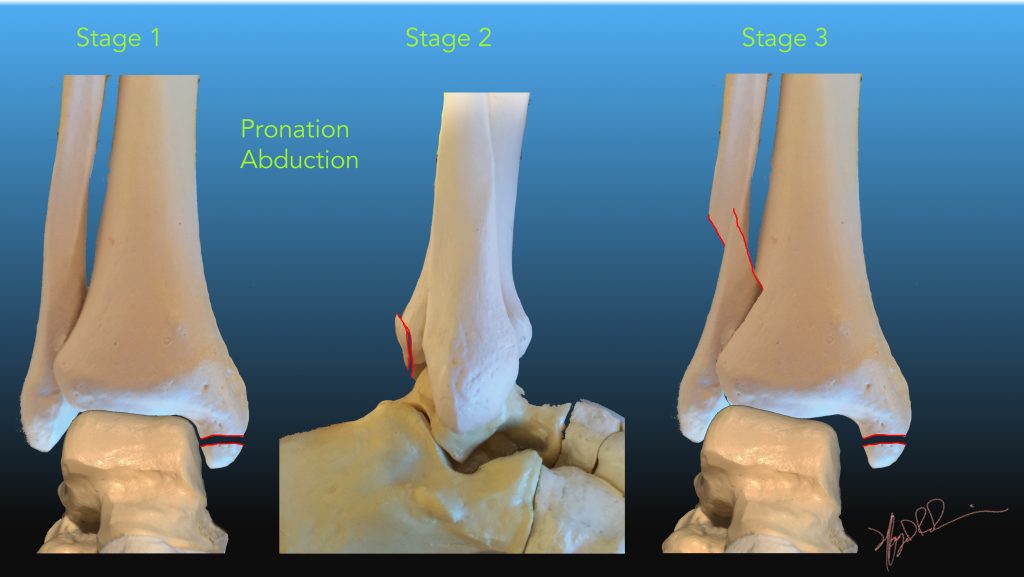 Lauge Hansen Classification of Ankle Fractures | UW Emergency Radiology