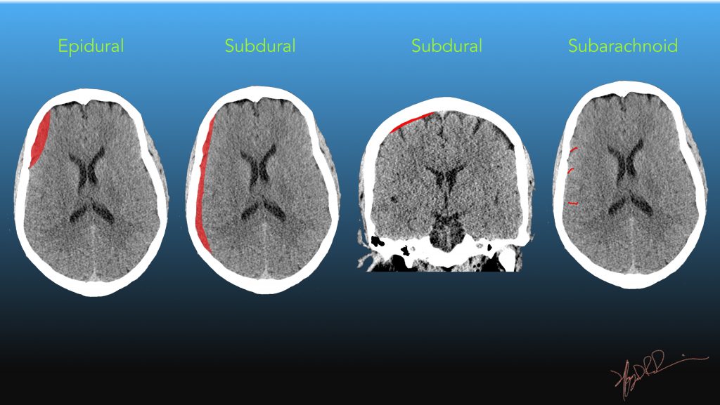 Subdural hematoma vs intracranial hemorrhage