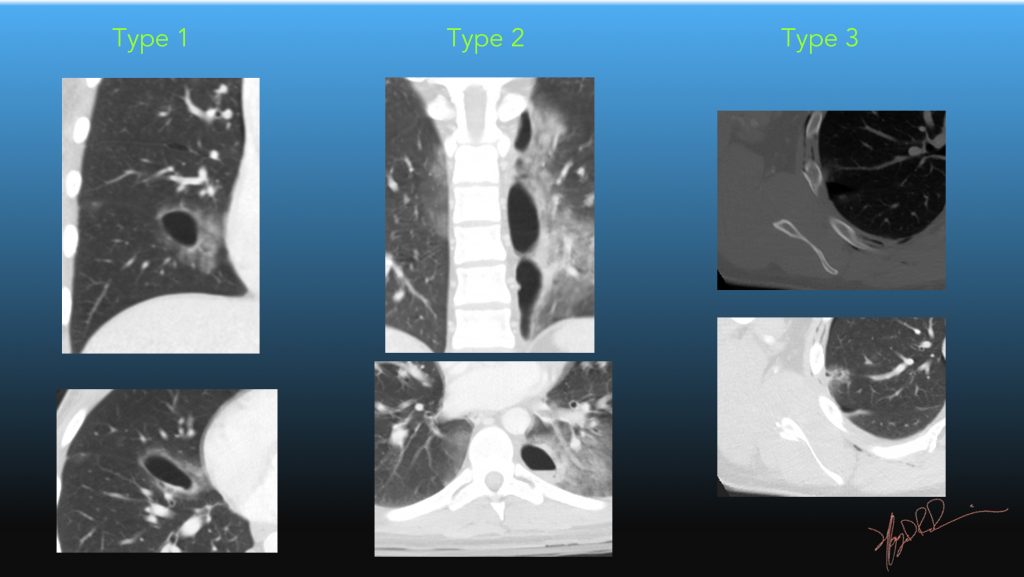Parenchymal injuries of the lung | UW Emergency Radiology