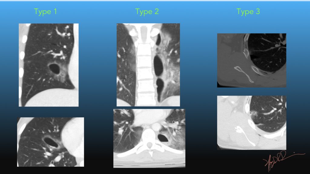 ct-scan-of-the-chest-showing-a-lobulated-mass-with-heterogeneous