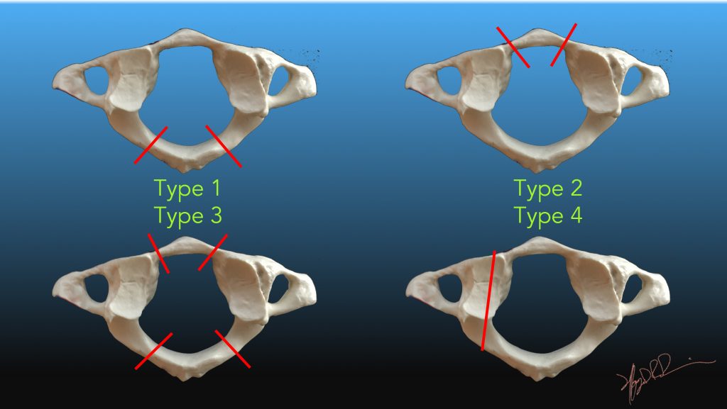 Jefferson Classification of C1 Fractures UW Emergency Radiology