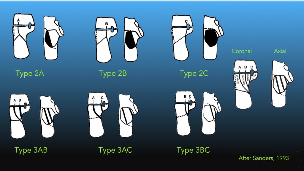 calcaneus fracture classification