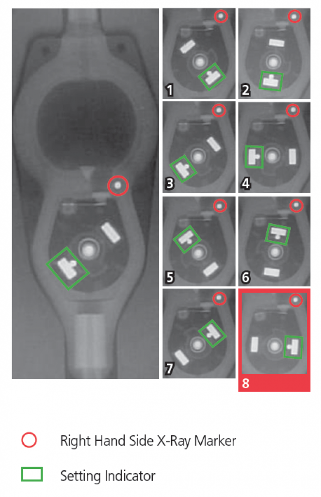 Determining Settings of Programmable VP Shunts | UW Emergency Radiology