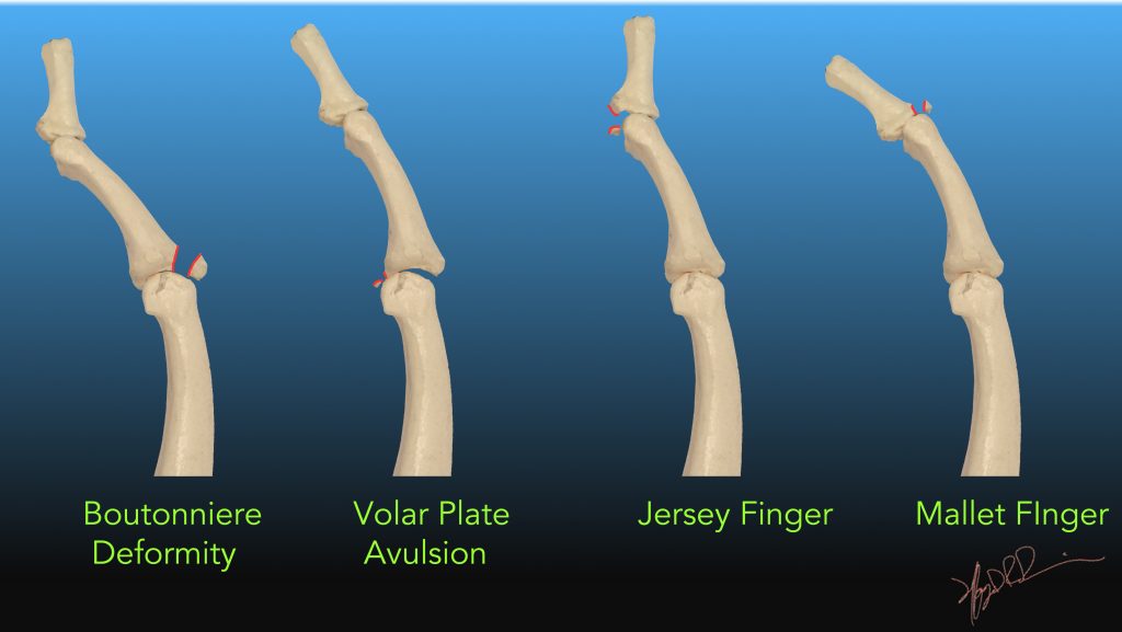What Is Chip Fracture Of Finger At Rafaela Woodruff Blog