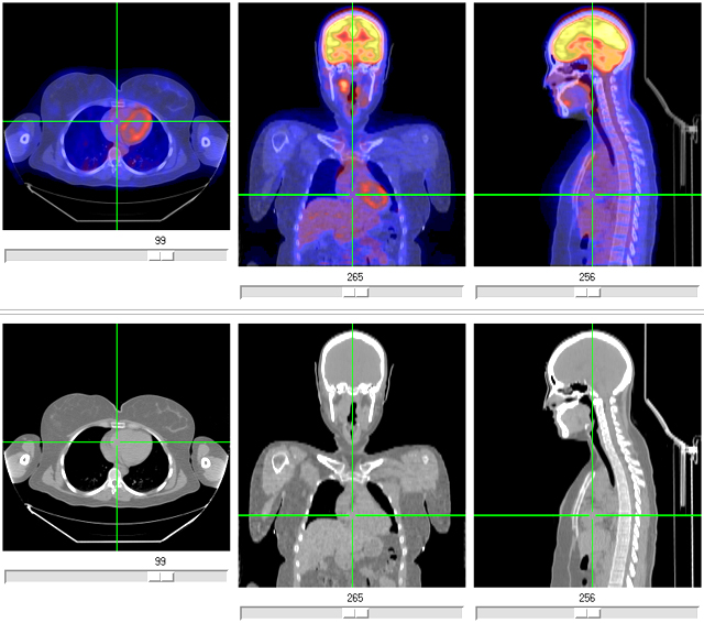 In the high-resolution x-ray computed tomography (CT) images on the bottom, 