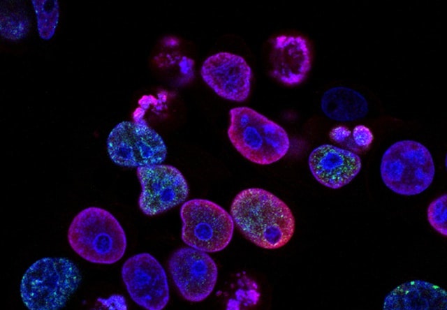 Colorectal cancer cells stained blue and purple.