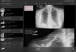 Several x-rays of my broken ribs and a clavicles.