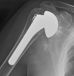 Tornier Shoulder Prostheses