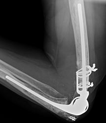 Elbow Prostheses