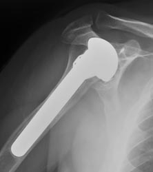 Zimmer Shoulder Prostheses