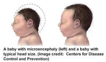 microencephaly