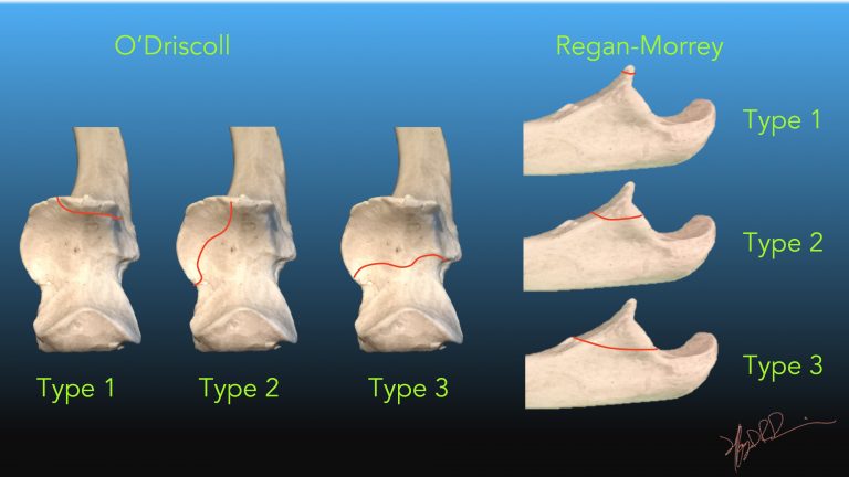 Morphological Analysis Of Fractures Of The Ulnar Coronoid Process ...