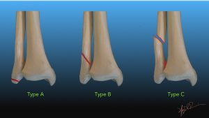tib fib fracture classification