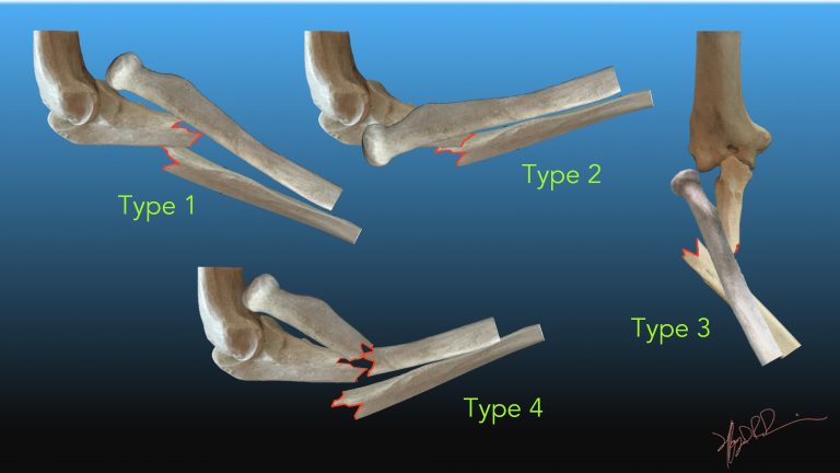 Bado Classification Of Monteggia Fractures 