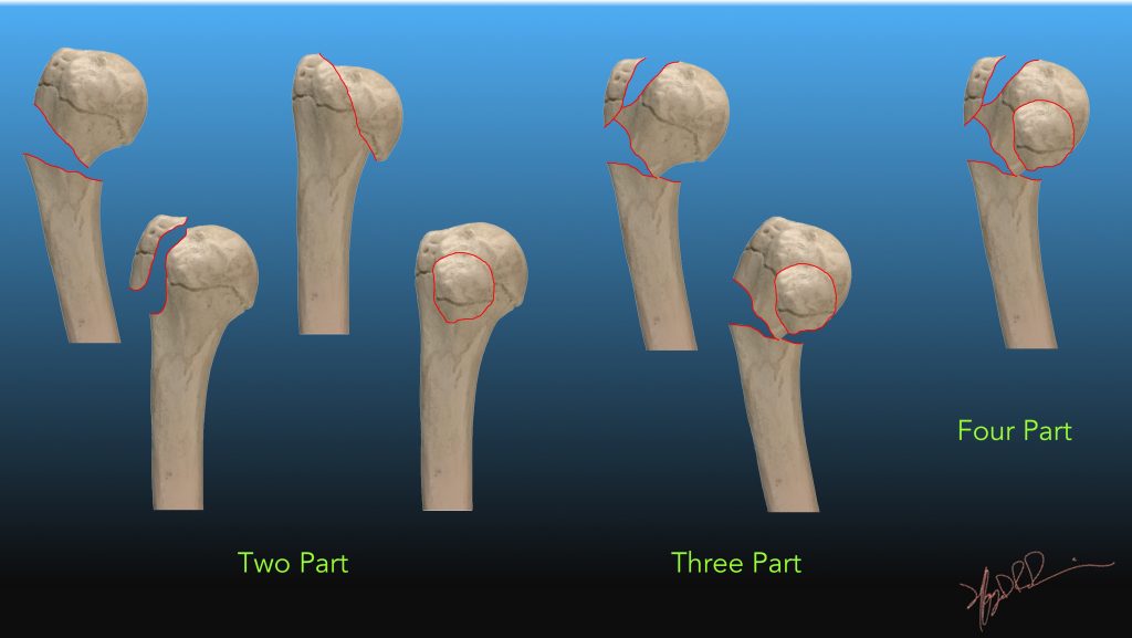 Proximal Humeral Fracture Classification