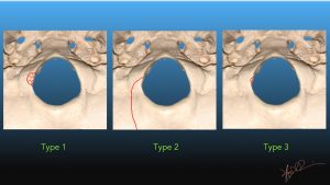 Occipital Condyle Fracture | UW Emergency Radiology