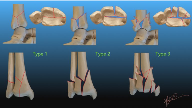 Ruedi And Allgower Classification Of Pilon Fractures | UW Emergency ...