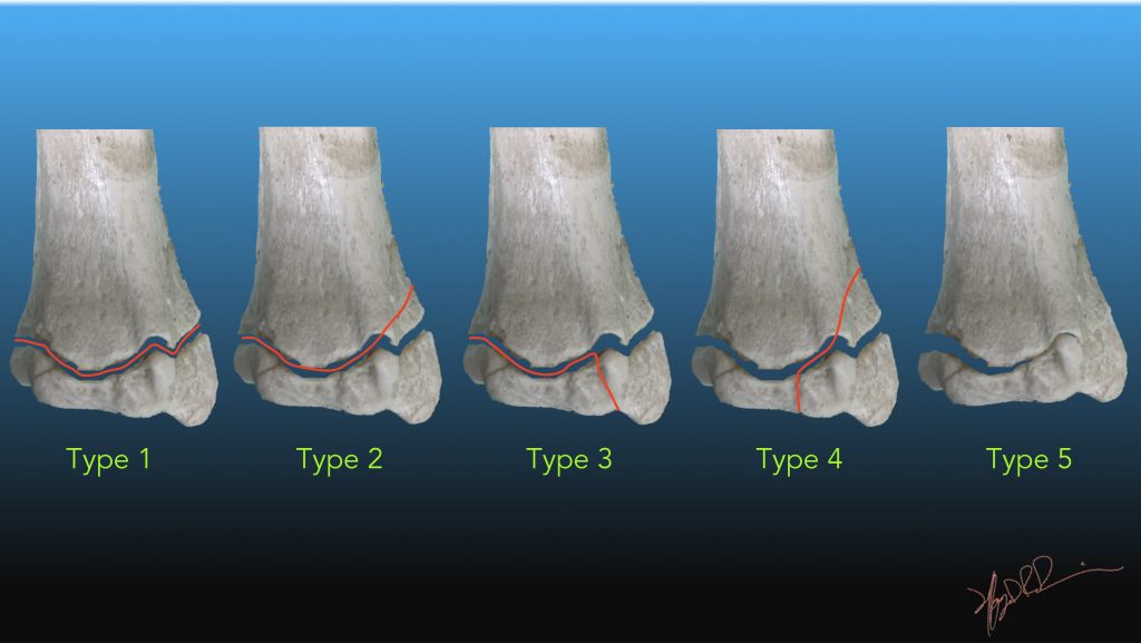 salter 1 fracture