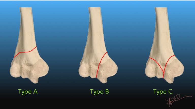 AO/OTA Classification of Distal Humeral Fractures | UW Emergency Radiology