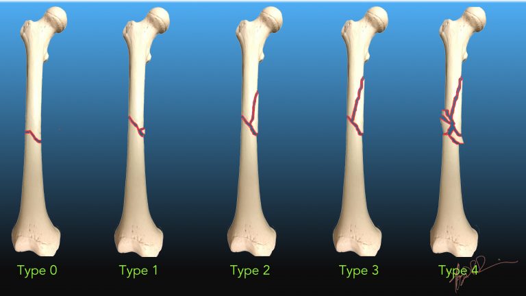 Winquist and Hansen Classification of Femoral Fractures | UW Emergency ...