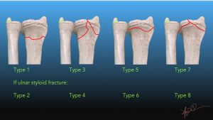 Frykman Classification of Distal Radial Fractures | UW Emergency Radiology