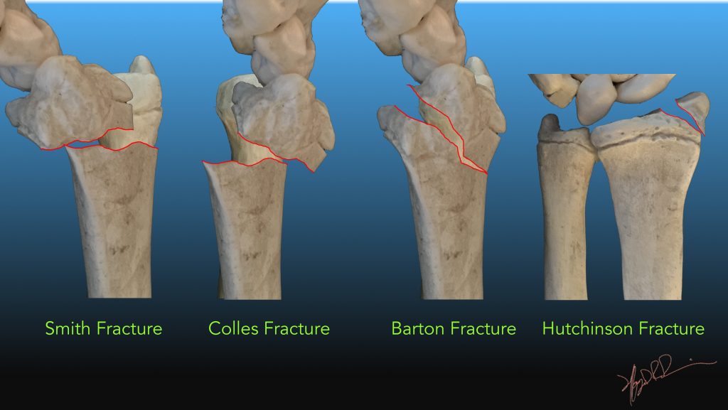 Common Distal Radial Fractures | UW Emergency Radiology