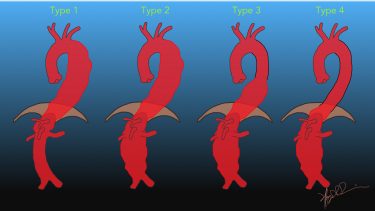 Taaa Classification Crawford Classification of Thoraco-abdominal Aneurysms | UW Emergency ...