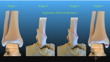 Lauge Hansen Classification of Ankle Fractures | UW Emergency Radiology