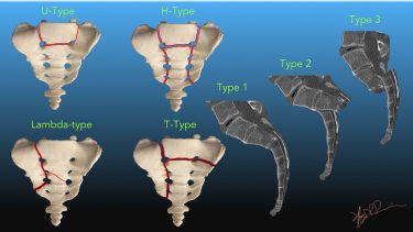 Classification of Transverse Sacral Fractures | UW Emergency Radiology