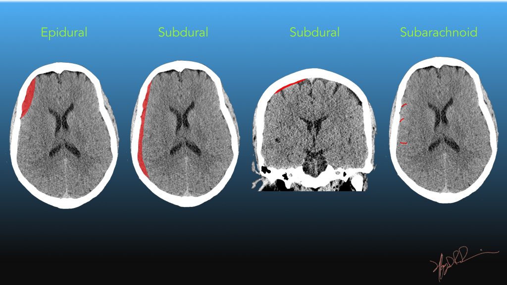Extra Axial Fluid Collections UW Emergency Radiology