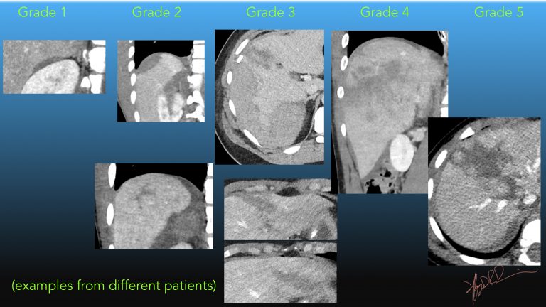 AAST Liver Injury Scale 2018 revision | UW Emergency Radiology