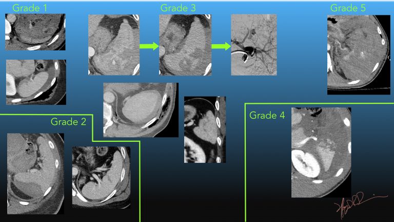 AAST Spleen Injury Scale 2018 revision | UW Emergency Radiology