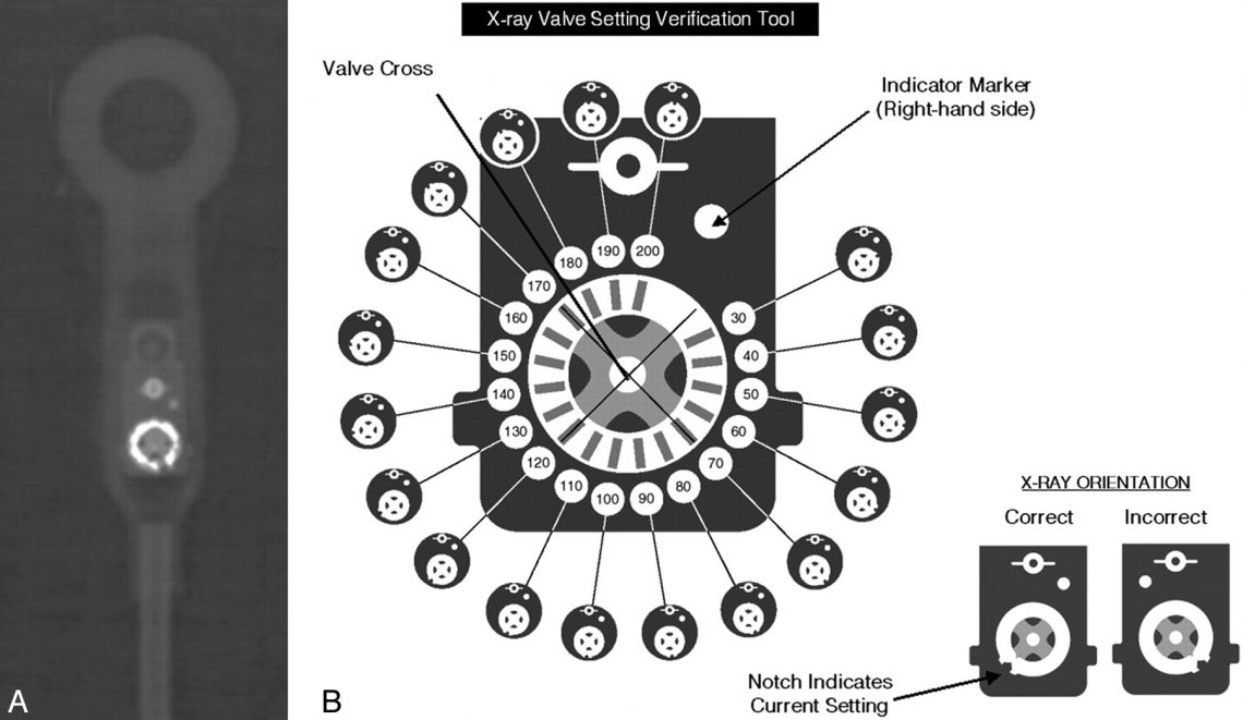 determining-settings-of-programmable-vp-shunts-uw-emergency-radiology