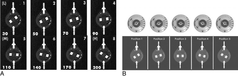 Determining Settings of Programmable VP Shunts | UW Emergency Radiology