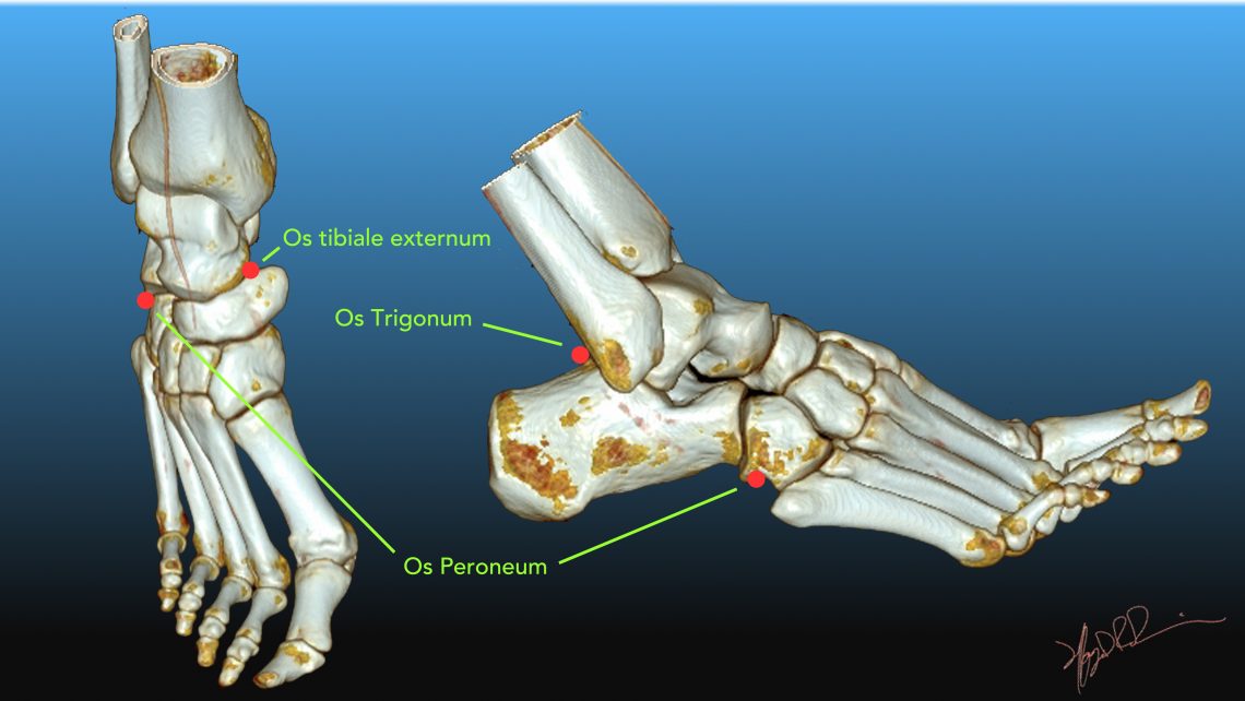 Common Accessory Ossicles of the Foot | UW Emergency Radiology