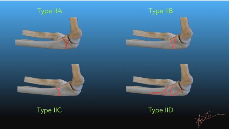 Jupiter Classification Of Bado Ii Montaggia Fractures 