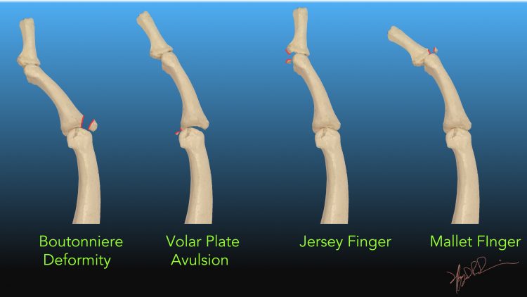 finger-fractures-uw-emergency-radiology