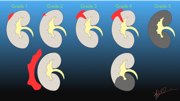 AAST Kidney Injury Scale | UW Emergency Radiology